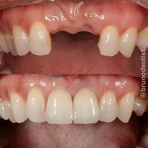 Replacement Of Missing Front Teeth With Dental Implants And Zirconia