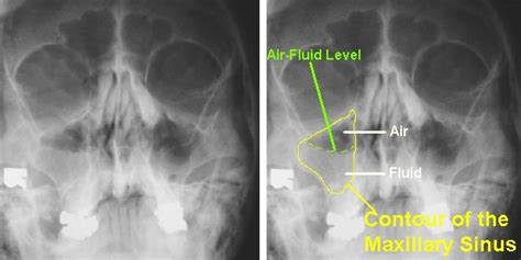 Imaging Of Maxillary Sinusitis Waters View Ct Scan Mri Otolaryngology Houston Diagnostic