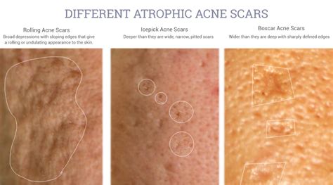 Acne Scar Treatment Needles Lasers And Radio Frequency Jivaka Beauty
