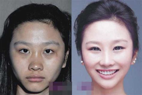 Chinese Women Before And After Plastic Surgery Procedures 19 Photos Klykercom