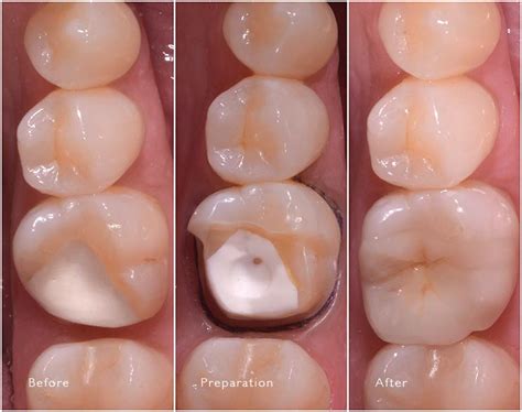Inlays Onlays The Prosthodontists