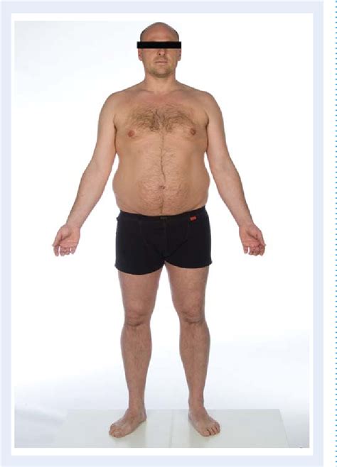 Klinefelters Syndrome Healthy Male Photograph By Science Source My