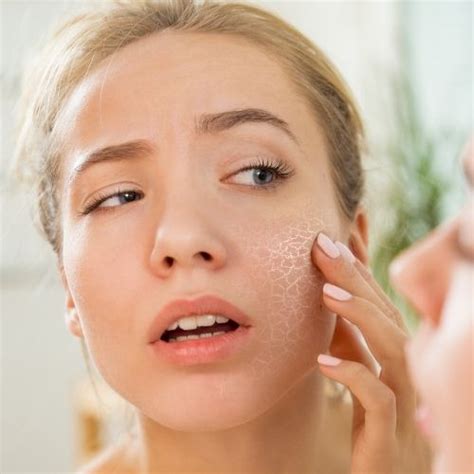 Dry And Flaky Complexion Heres How To Deal With Winter Skin Skin Elite