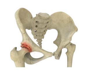 Hip Osteoarthritis Sydney Nsw Hip Joint Replacement Surgery Randwick