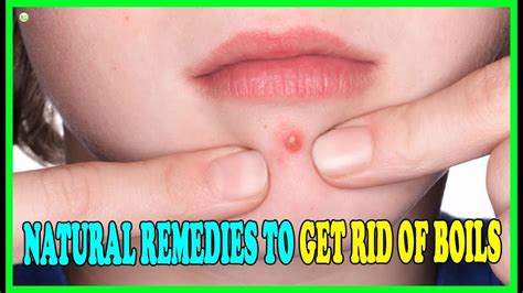 5 Effective Natural Home Remedies For Boils How To Get Rid Of Boils