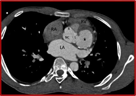 Cureus Rupture Of Sinus Of Valsalva Aneurysm Into Interventricular