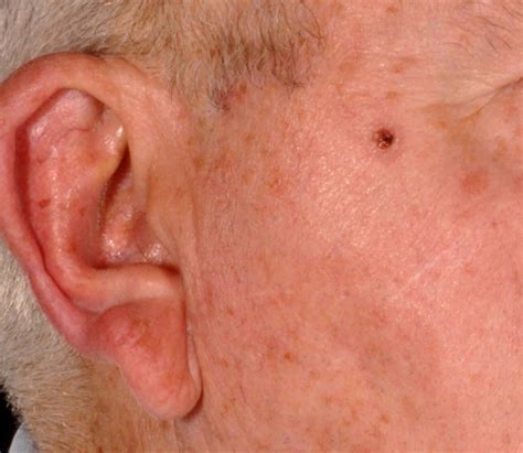 A 79 Year Old Man With A Lesion On His Cheek The Bmj