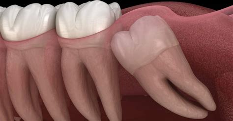 Wisdom Teeth Removal Dr Alistair’s Comprehensive Guide Mona Vale Dental