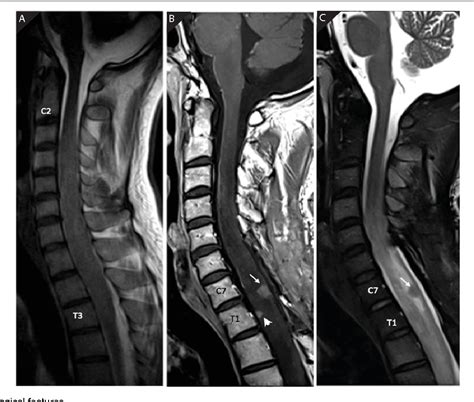 Figure 1 From Subependymoma Of The Cervicothoracic Spinal Cord