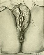 Diseases Of The Vulva Obgyn Key My XXX Hot Girl