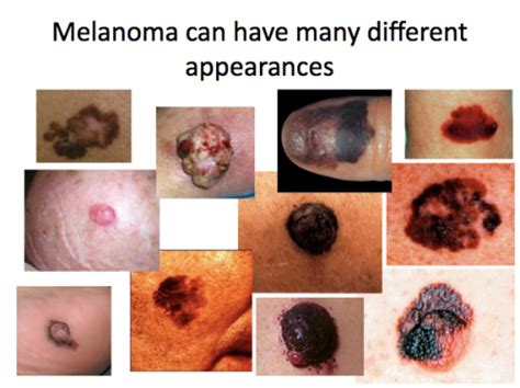 Melanoma is the deadliest form of skin cancer, but it's often treatable if caught at an early stage. Guia definitiva para diferenciar lunares verrugas y ...