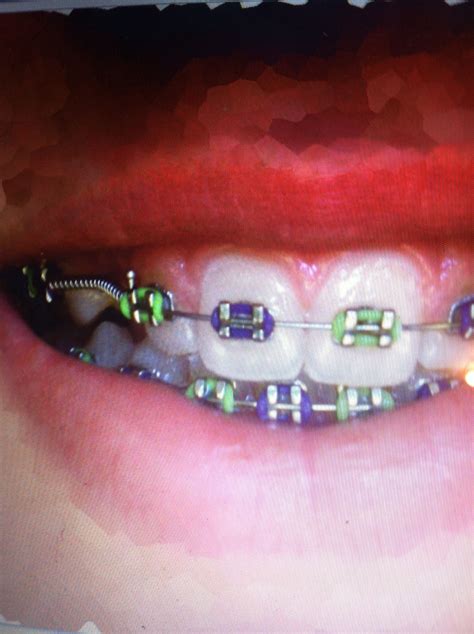 Braces Green And Purple Green Braces Braces Colors Teeth Braces