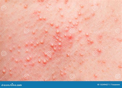 Allergic Rash Stock Image Image Of Girl Condition Patient 13249427