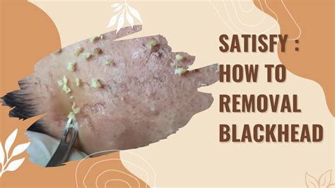satisfy how to removal blackhead youtube