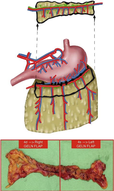 Figure 1 From Histo Anatomical Basis Of The Gastroepiploic Vascularized