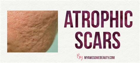 Scar Removal Treatments The Best Treatments With Pros And Cons