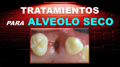 Tratamientos De Alveolo Seco Dental Necrotico Septico Osteitis Alveolar Alveolitis O Alveolalgia