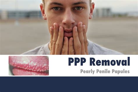 รักษาผื่นนูนพีพีพี Ppp Removal Pearly Penile Papules Cmcwellbeing