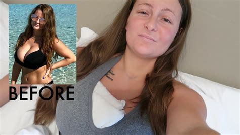 Breast Reduction Surgery 1 Week Post Op Pictures Faqs More Youtube