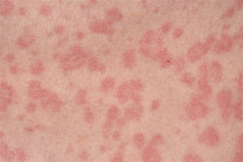 Skin Rashes Red Flag Symptoms Gponline