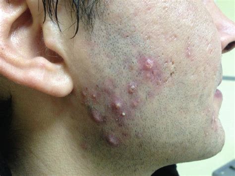 Severe Recalcitrant Nodular Acne Diagnosis And Treatment Of Acne