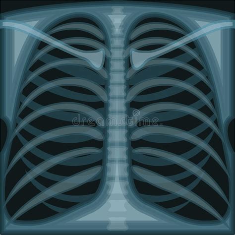 Chest X Ray Stock Vector Image 41538023