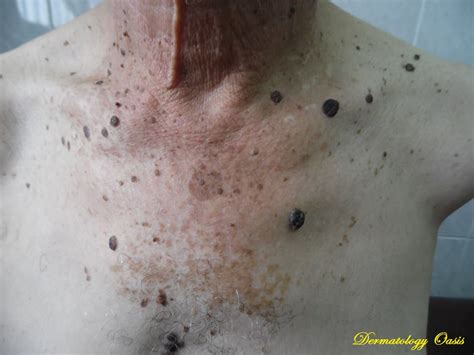 Multiple Seborrheic Keratosis Dermatology Oasis