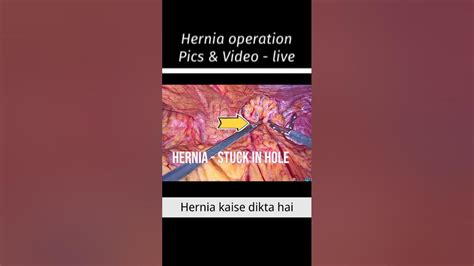 Live Operation Kaise Hota Hai Hernia Ke Liye Hernia Kaise Theek