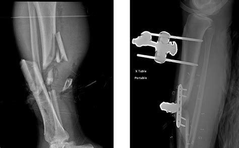 The Radiograph Of The Right Tibia Fibula Fracture Before Left And