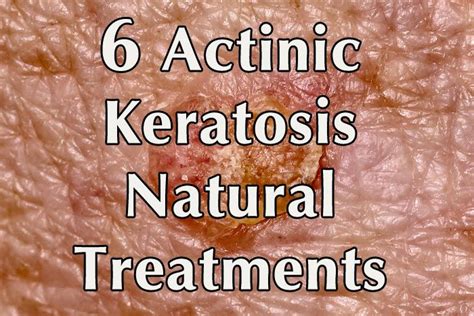 6 Actinic Keratosis Natural Treatments Healthy Focus Natural
