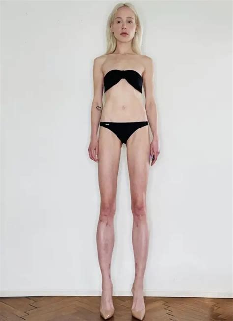 modella tedesca si fa allungare le gambe 14cm per compiacere il marito berlino magazine