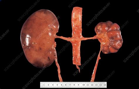 Unilateral Atrophy Of Kidney Stock Image C0383709 Science Photo
