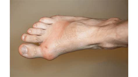9 Pictures Of The Gout Symptoms Food To Avoid Other Tips