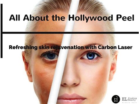 Hollywood Peel Skin Rejuvenation With Carbon Laser Facial Laser