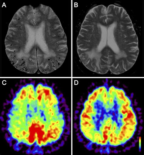 Figure Mri And Pet Scans Of Case A Brain Mri Showed Cortical And