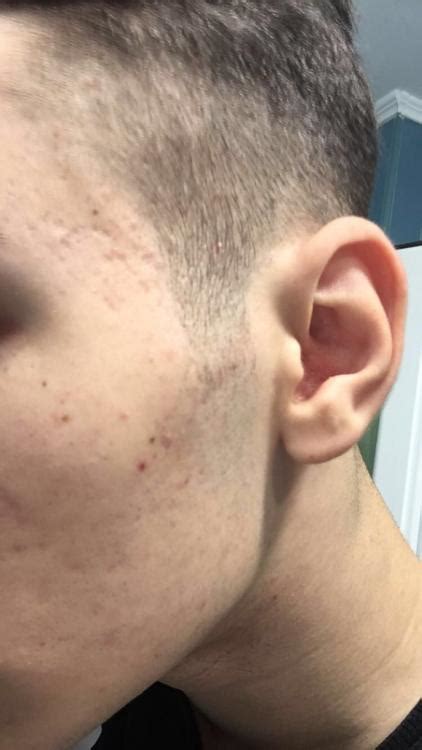 Acne Scars After Accutane Pics Scar Treatments Forum