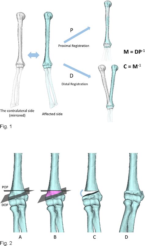 Figure 1 From Three Dimensional Corrective Osteotomy For Cubitus Varus