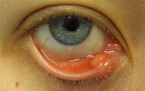 They are often blind pimples, which means they do not have a head. Pimple on Eyelid, Under, Inside, on Rim, Small White Lump ...