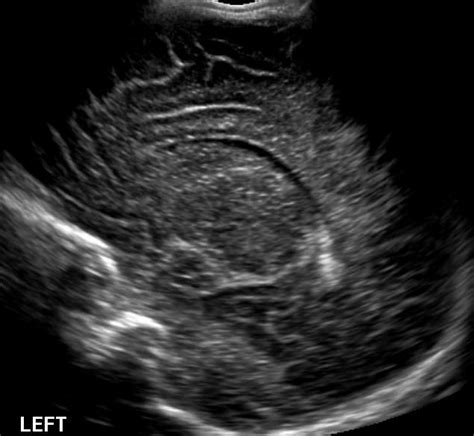 Neonatal Brain Normal Parasagittal Neonatal Ultrasound Sonography