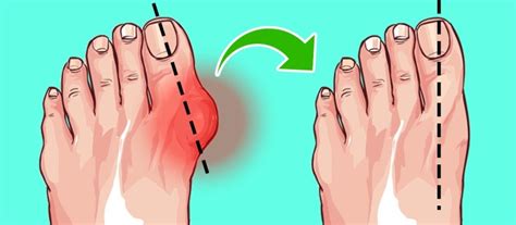 However, the speed of formation and severity of deformity can be affected although preventing bunions is not possible, shoes can and do affect the severity of the anatomical changes that occur in bunion formation and. 5 Ways To Naturally Shrink Your Bunions Without Surgery ...
