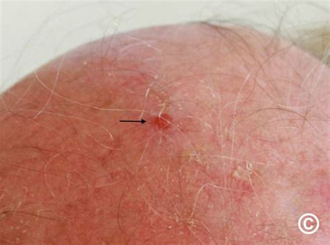 Early Squamous Cell Carcinoma Scalp
