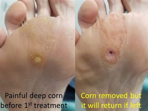 How To Cure Corns Health First Foot And Gait Clinic