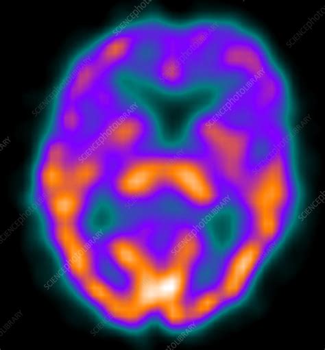Depression Spect Ct Scan Stock Image C0393577 Science Photo Library