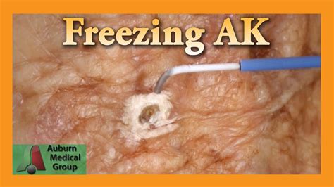 Actinic keratosis is a kind of skin disease which is caused by too much exposure to the sun. Freezing Hand Actinic Keratosis with Liquid Nitrogen ...