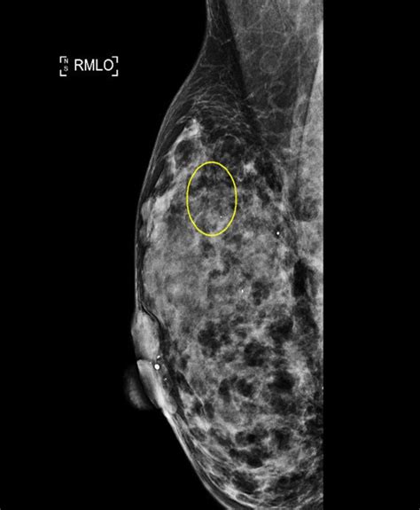 Right Mammogram Mediolateral Oblique View Showing Small Indeterminate