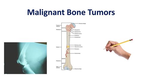 Malignant Bone Tumors Usmle Comlex Nclex Youtube