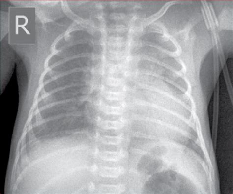 Ground Glass Appearance On Chest X Ray Of A Patient With Hyaline