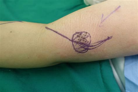 Unusual Presentation Of Primary Cutaneous Melanoma Of The Forearm With