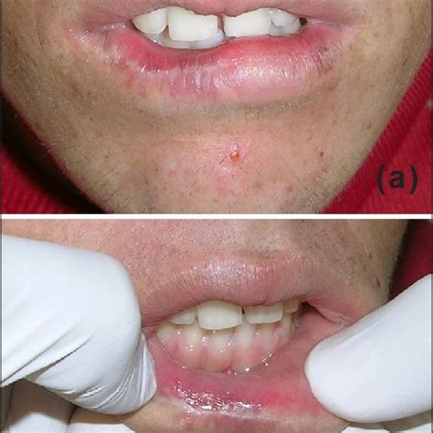 Pdf Uncommon Occurrence Of Lip Squamous Cell Carcinoma In A Pediatric