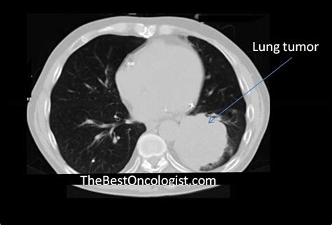 How Lung Cancer Is Diagnosed The Best Oncologist Tm